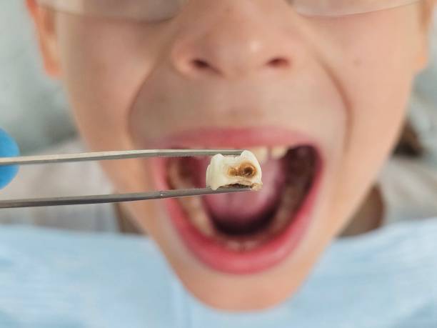 Best Emergency Dental Care for Broken or Chipped Teeth in Austell, GA